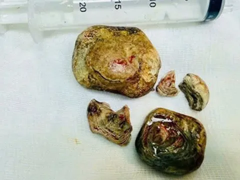 Người đàn ông 43 tuổi "bụng cứng như đá", bác sĩ phát hiện bí mật "đáng sợ"